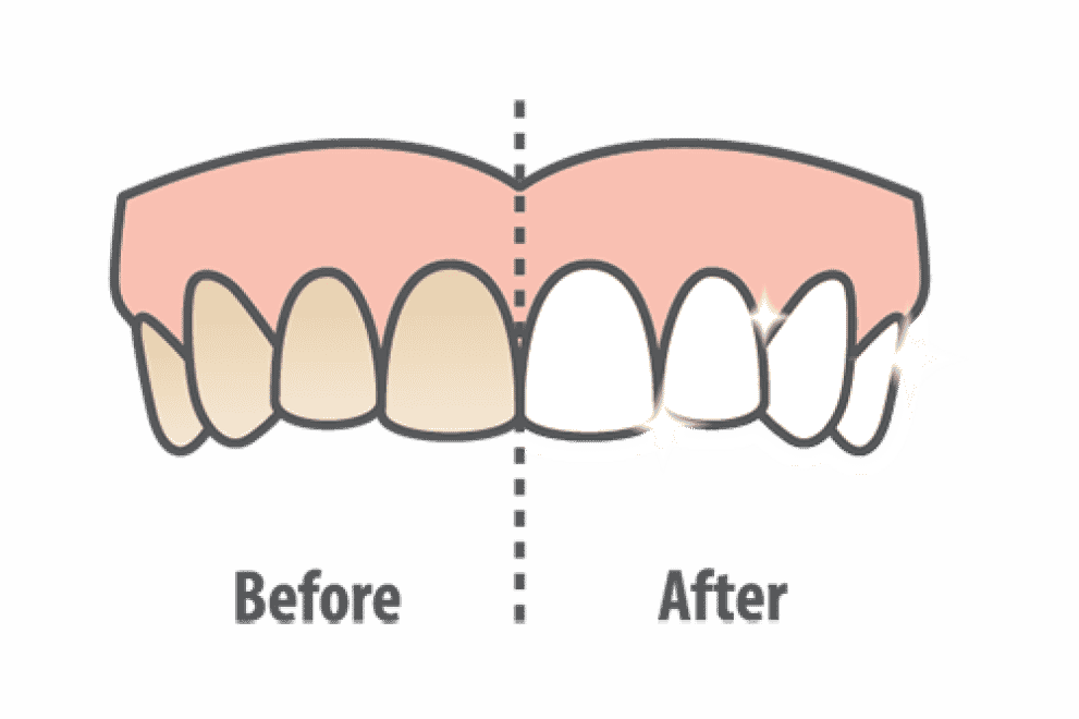 Teeth whitening before and after in Saginaw, TX