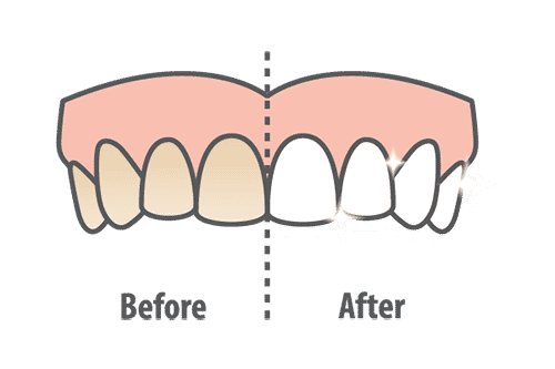 Teeth whitening before and after