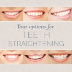 Your Options for Teeth Straightening