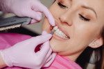 4 Advantages of Dental Veneers