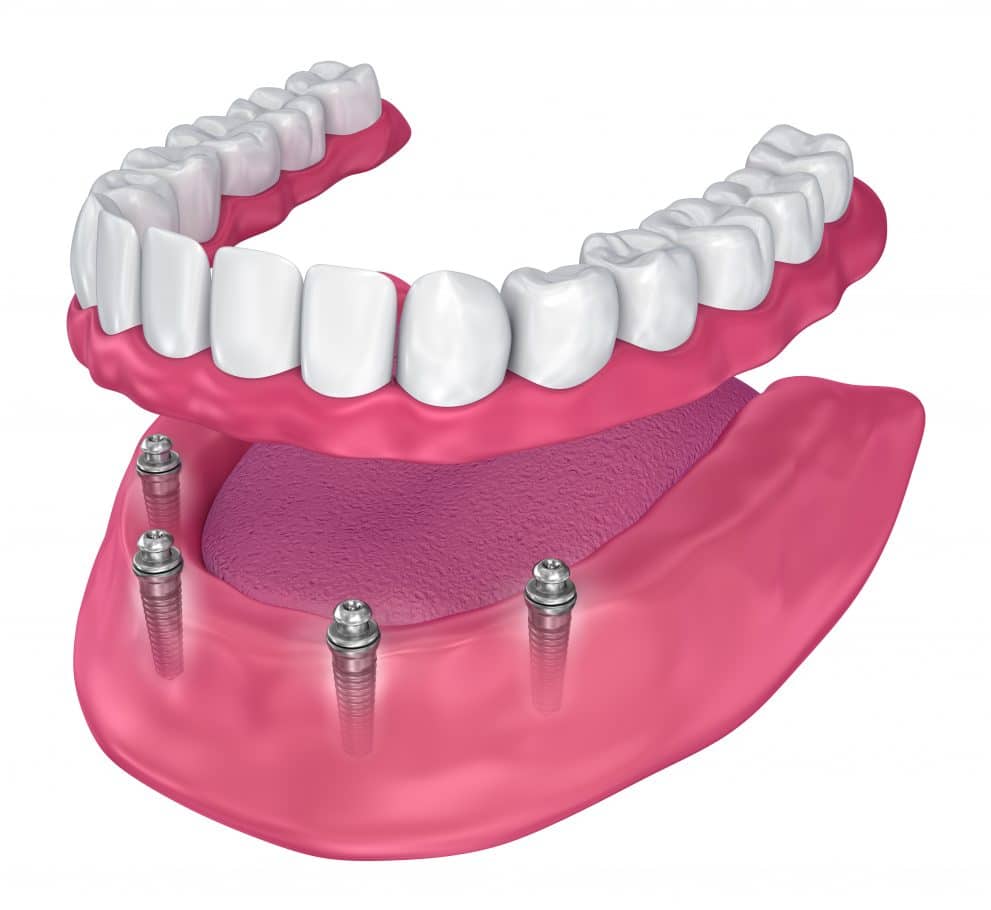 all-on-4 dental implants in Saginaw, Texas